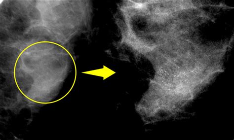 微細石灰化の集簇|乳がん／マンモグラフィ検査(3) 白い影が等間隔では。